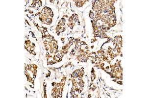 Immunohistochemistry of paraffin-embedded human breast cancer using [KO Validated] MyD88 Rabbit mAb (ABIN7268723) at dilution of 1:1000 (40x lens). (MYD88 抗体)
