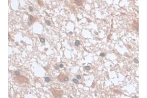 Detection of UCP2 in Human Glioma Tissue using Monoclonal Antibody to Mitochondrial Uncoupling Protein 2 (UCP2) (UCP2 抗体  (AA 154-289))