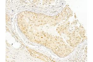 ABIN6255153 and ABIN6267596 at 1/100 staining Human breast cancer by IHC-P. (NF-kB p65 抗体  (pSer276))