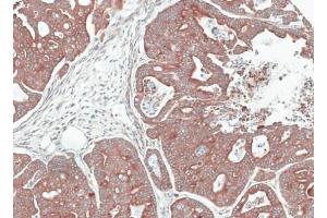 IHC-P Image Immunohistochemical analysis of paraffin-embedded gastric cancer N87 xenograft, using NOV, antibody at 1:100 dilution. (NOV 抗体  (Center))