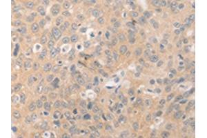 The image on the left is immunohistochemistry of paraffin-embedded Human ovarian cancer tissue using ABIN7189978(BEST1 Antibody) at dilution 1/20, on the right is treated with synthetic peptide. (Bestrophin 1 抗体)