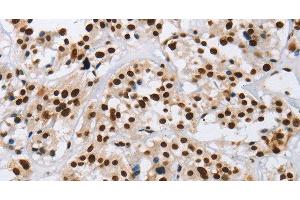 Immunohistochemistry of paraffin-embedded Human thyroid cancer using IL17C Polyclonal Antibody at dilution of 1:50 (IL17C 抗体)