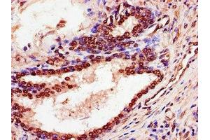 Immunohistochemistry of paraffin-embedded human prostate cancer using ABIN7168587 at dilution of 1:100 (SPDEF/PSE 抗体  (AA 145-247))