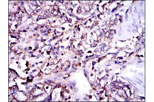 Immunohistochemical analysis of paraffin-embedded stomach cancer tissues using G6PD mouse mAb with DAB staining. (Glucose-6-Phosphate Dehydrogenase 抗体)