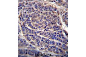 CA6 Antibody (C-term) (ABIN656592 and ABIN2845853) immunohistochemistry analysis in formalin fixed and paraffin embedded human melanoma followed by peroxidase conjugation of the secondary antibody and DAB staining. (CA6 抗体  (C-Term))