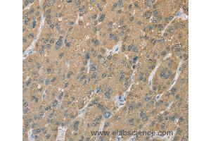 Immunohistochemistry of Human gastric cancer using CYP2C9 Polyclonal Antibody at dilution of 1:50 (CYP2C9 抗体)