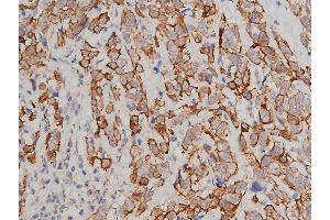 ABIN6267311 at 1/200 staining human breast cancer tissue sections by IHC-P.