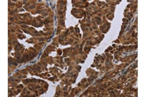 The image on the left is immunohistochemistry of paraffin-embedded Human ovarian cancer tissue using ABIN7191351(MAGEB3 Antibody) at dilution 1/20, on the right is treated with synthetic peptide. (MAGEB3 抗体)
