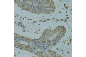Immunohistochemistry of paraffin-embedded human breast cancer using DGKQ antibody (ABIN1872259) at dilution of 1:100 (40x lens). (DGKQ 抗体)