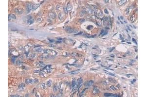 DAB staining on IHC-P; Samples: Human Colorectal cancer Tissue (LGALS3BP 抗体  (AA 24-221))