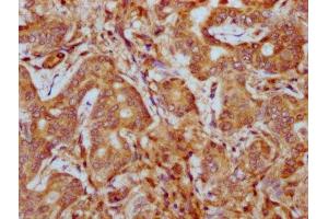 IHC image of ABIN7163100 diluted at 1:400 and staining in paraffin-embedded human liver cancer performed on a Leica BondTM system. (PHACTR1 抗体  (AA 263-387))