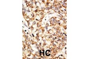 Formalin-fixed and paraffin-embedded human cancer tissue reacted with the primary antibody, which was peroxidase-conjugated to the secondary antibody, followed by DAB staining. (APOBEC1 抗体  (N-Term))