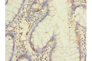Immunohistochemistry of paraffin-embedded human colon cancer using ABIN7150013 at dilution of 1:100 (DIS3L 抗体  (AA 1-300))