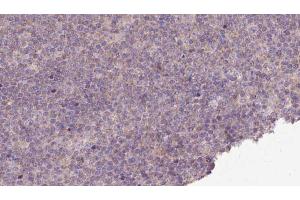 ABIN6273149 at 1/100 staining Human lymph cancer tissue by IHC-P. (PMPCB 抗体  (Internal Region))