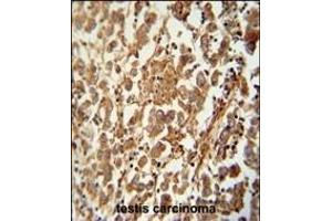 STC1 antibody (N-term) (ABIN654579 and ABIN2844281) immunohistochemistry analysis in formalin fixed and raffin embedded human testis carcinoma followed by peroxidase conjugation of the secondary antibody and DAB staining.