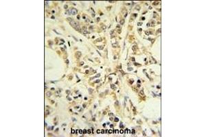 RPS13 Antibody (Center) (ABIN650998 and ABIN2840031) IHC analysis in formalin fixed and paraffin embedded breast carcinoma followed by peroxidase conjugation of the secondary antibody and DAB staining. (RPS13 抗体  (AA 82-110))