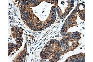 Immunohistochemical staining of paraffin-embedded Adenocarcinoma of colon tissue using anti-FAHD2Amouse monoclonal antibody. (FAHD2A 抗体)