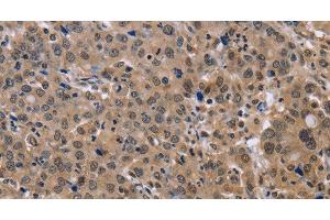 Immunohistochemistry of paraffin-embedded Human liver cancer tissue using KIF25 Polyclonal Antibody at dilution 1:40 (KIF25 抗体)