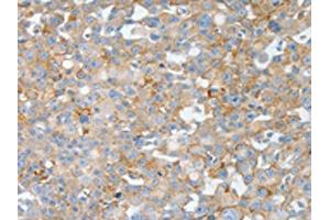 The image on the left is immunohistochemistry of paraffin-embedded Human breast cancer tissue using ABIN7190004(BPIFB2 Antibody) at dilution 1/50, on the right is treated with synthetic peptide. (BPIL1 抗体)