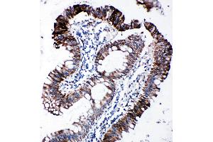 Anti-EIF2S1 antibody, IHC(P) IHC(P): Human Intestinal Cancer Tissue