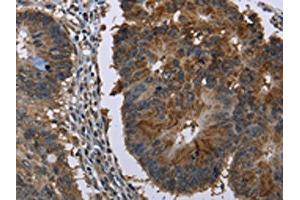 The image on the left is immunohistochemistry of paraffin-embedded Human colon cancer tissue using ABIN7129746(HSD17B6 Antibody) at dilution 1/20, on the right is treated with fusion protein. (HSD17B6 抗体)