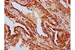 IHC image of ABIN7156973 diluted at 1:400 and staining in paraffin-embedded human prostate cancer performed on a Leica BondTM system. (IFT172 抗体  (AA 1368-1502))