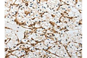 The image on the left is immunohistochemistry of paraffin-embedded Human renal cancer tissue using ABIN7193081(YBX1 Antibody) at dilution 1/15, on the right is treated with synthetic peptide.