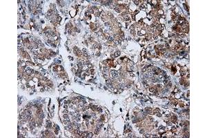 Immunohistochemical staining of paraffin-embedded Carcinoma of liver tissue using anti-LIPG mouse monoclonal antibody. (LIPG 抗体)