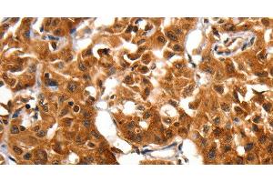 Immunohistochemistry of paraffin-embedded Human lung cancer using ADAP1 Polyclonal Antibody at dilution of 1:60 (ADAP1 抗体)