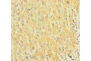 Immunohistochemistry of paraffin-embedded human liver cancer using ABIN7170610 at dilution of 1:100 (SPIN4 抗体  (AA 1-249))