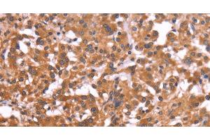 Immunohistochemistry of paraffin-embedded Human thyroid cancer tissue using CRISP3 Polyclonal Antibody at dilution 1:50 (CRISP3 抗体)