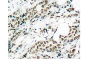 Immunohistochemistry of paraffin-embedded Human breast carcinoma tissue, using Phospho-FOXO4(S197) Polyclonal Antibody (FOXO4 抗体  (pSer197))