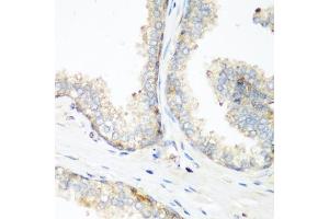 Immunohistochemistry of paraffin-embedded human prostate using NEDD4 antibody (ABIN1681009, ABIN3015207, ABIN3015208 and ABIN6213883) at dilution of 1:200 (40x lens). (NEDD4 抗体  (AA 160-460))