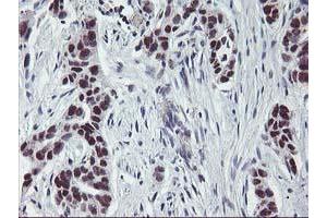 Immunohistochemical staining of paraffin-embedded Carcinoma of Human lung tissue using anti-ANKRD53 mouse monoclonal antibody. (ANKRD53 抗体  (AA 1-300))