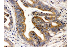 Anti-Rab5 Picoband antibody,IHC(P) IHC(P): Human Intestinal Cancer Tissue (RAB5 抗体  (C-Term))