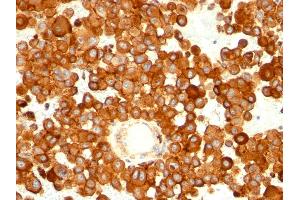 Formalin-fixed, paraffin-embedded human melanoma stained with CD63 Mouse Monoclonal Antibody (MX-49. (CD63 抗体)