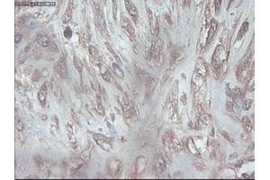 Immunohistochemical staining of paraffin-embedded Carcinoma of pancreas using anti-PDX1 (ABIN2452675) mouse monoclonal antibody.