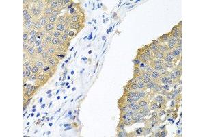 Immunohistochemistry of paraffin-embedded Human lung cancer using EIF4E Polyclonal Antibody at dilution of 1:100 (40x lens). (EIF4E 抗体)