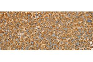 Immunohistochemistry of paraffin-embedded Human liver cancer tissue using VDAC2 Polyclonal Antibody at dilution of 1:25(x200) (VDAC2 抗体)