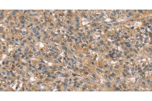 Immunohistochemistry of paraffin-embedded Human liver cancer using SSX2IP Polyclonal Antibody at dilution of 1:45 (SSX2IP 抗体)