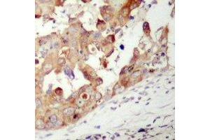 Immunohistochemical analysis of PAK1 staining in human prostate cancer formalin fixed paraffin embedded tissue section. (PAK1 抗体)