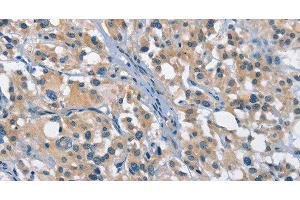 Immunohistochemistry of paraffin-embedded Human thyroid cancer tissue using GAS2 Polyclonal Antibody at dilution 1:50 (GAS2 抗体)