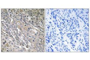 Immunohistochemistry analysis of paraffin-embedded human lung carcinoma tissue using ARHGEF9 antibody. (Arhgef9 抗体  (C-Term))