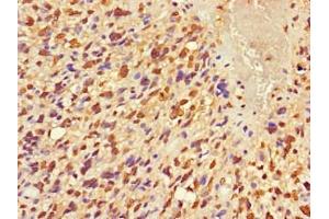 Immunohistochemistry of paraffin-embedded human glioma using ABIN7152681 at dilution of 1:100 (FRMD5 抗体  (AA 295-504))