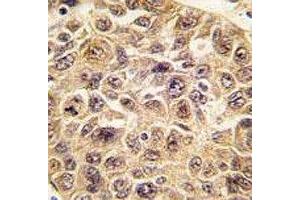 IHC analysis of FFPE human hepatocarcinoma tissue stained with anti-Ubiquitin antibody (Ubiquitin 抗体  (AA 1-32))