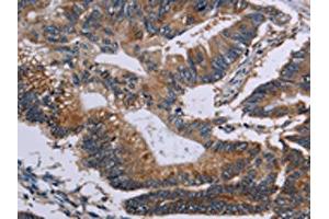 The image on the left is immunohistochemistry of paraffin-embedded Human colon cancer tissue using ABIN7128956(CLDND1 Antibody) at dilution 1/50, on the right is treated with fusion protein. (CLDND1 抗体)