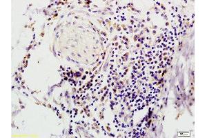 Formalin-fixed and paraffin embedded human colon carcinoma tissue with Anti-IFABP Polyclonal Antibody, Unconjugated  at 1:200, followed by conjugation to the secondary antibody and DAB staining (FABP2 抗体  (AA 45-132))
