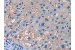 Detection of ITGb5 in Human Liver cancer Tissue using Polyclonal Antibody to Integrin Beta 5 (ITGb5) (Integrin beta 5 抗体  (AA 137-378))