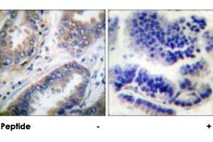Immunohistochemical analysis of paraffin-embedded human lung carcinoma tissue using CASP9 polyclonal antibody . (Caspase 9 抗体)