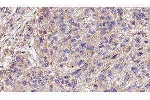 ABIN6278573 at 1/100 staining Human melanoma tissue by IHC-P. (GAS6 抗体  (Internal Region))